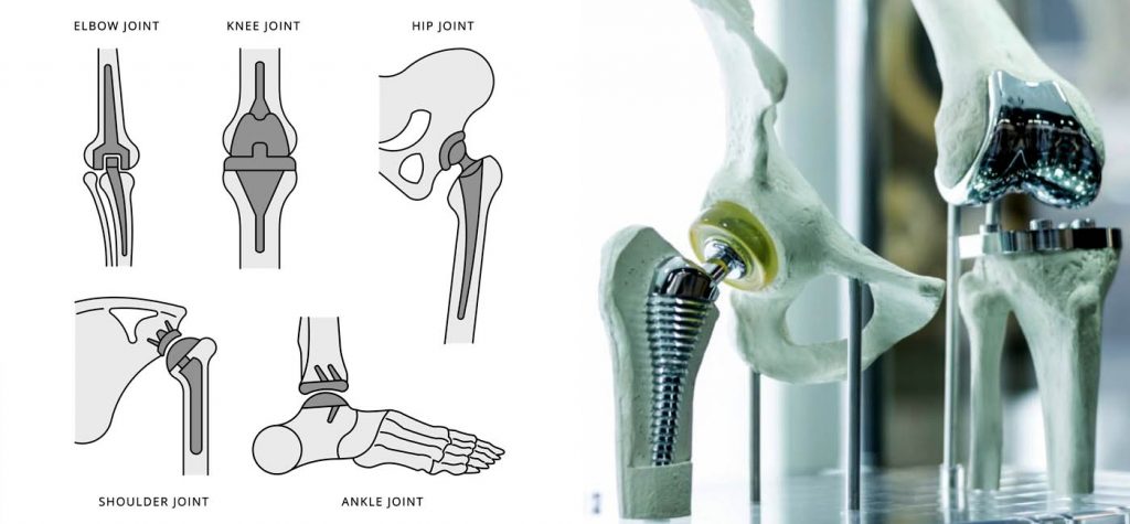 Many prospective patients for surgery are want to know about  surgery cost . It maybe above lakh as per condition and may be come under mediclaim at our hospitals. But remember you should operate your surgery by best joint replacement surgeon in Kolkata