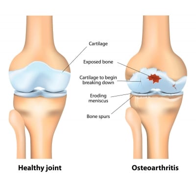 Osteoarthritis Doctor in Kolkata